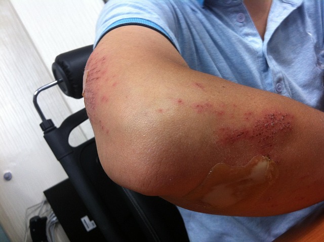 albany-personal-injury-claim-640x480-13815513.jpeg